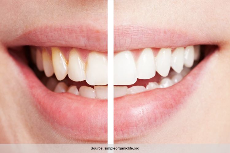 Top 8 Causes Of White Gums Around Teeth