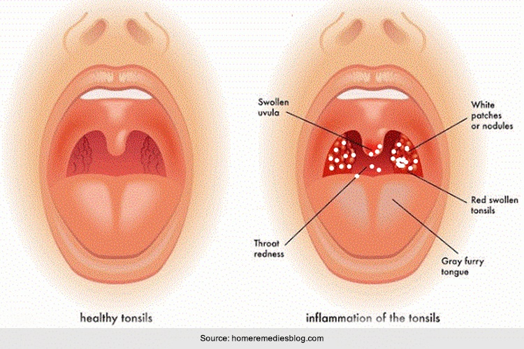 White Pustules In Throat 89