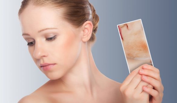 Decrease Redness Of Pimple