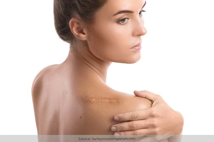 How To Get Rid Of a Keloid Scar