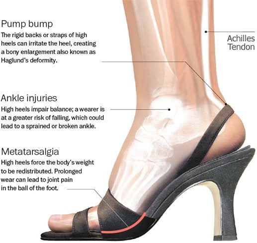 The Risks of Wearing Heels to Work Every Day