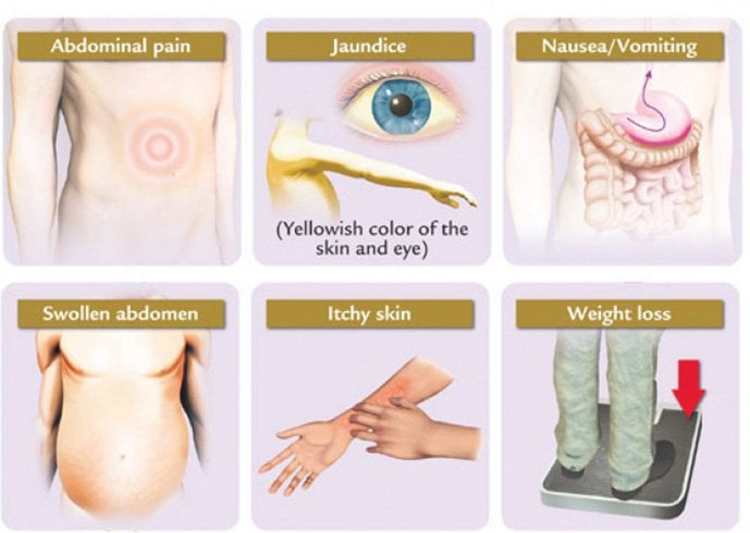 Symptoms of Jaundice