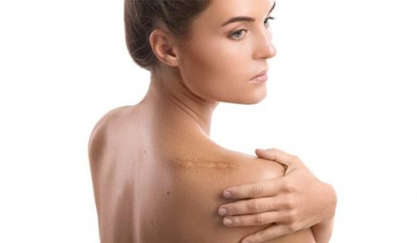 Ways To Get Rid Of a Keloid Scar