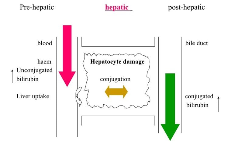 What Causes Jaundice