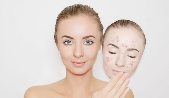 Tips To Prevent Breakouts