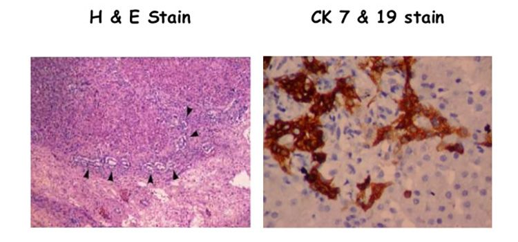 Liver Biopsy