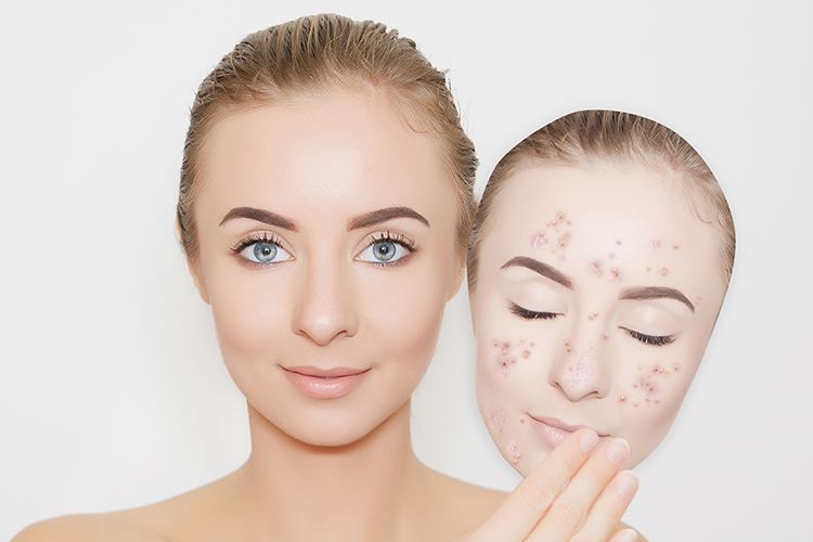 Tips To Prevent Breakouts