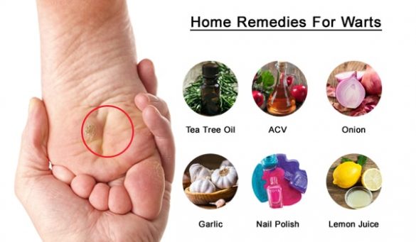 Home Remedies To Get Rid Of Warts Naturally