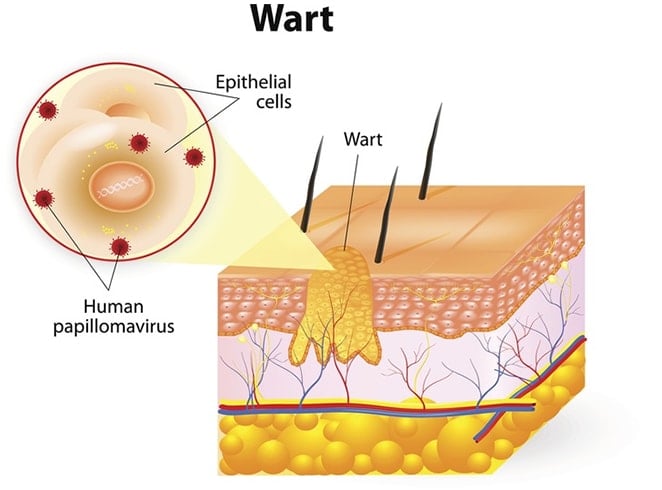 Best Way To Remove Warts On Face