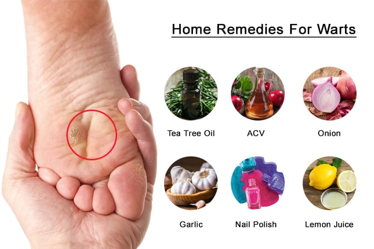 Home Remedies To Get Rid Of Warts Naturally