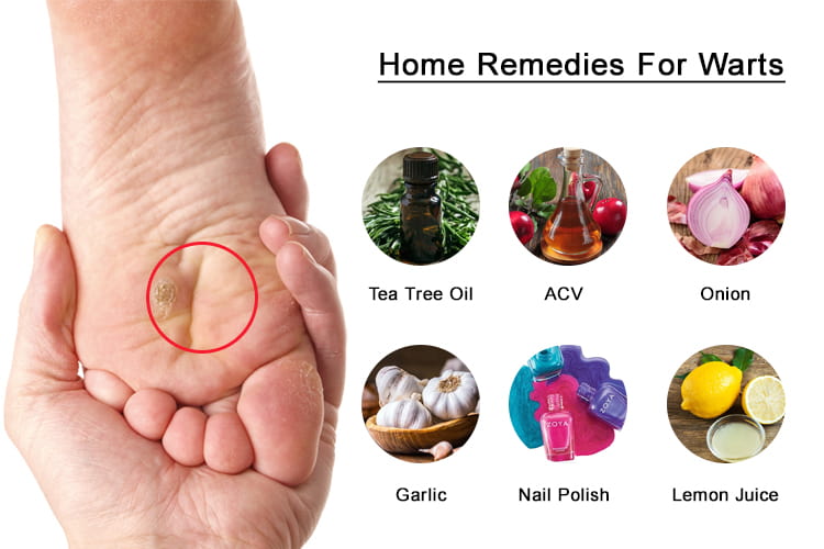 Home Remedies For Warts Helene Kovacevic Home Remedies For Warts Helene Kovacevic
