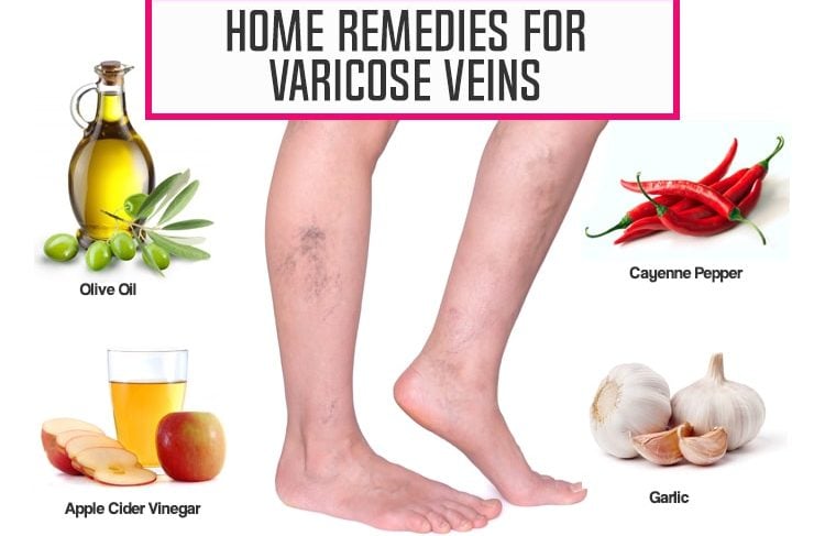 Home Remedies for Varicose Veins