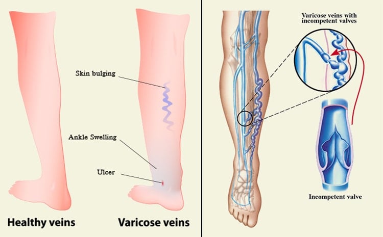 Symptoms Of Varicose Veins