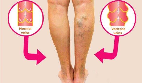 Varicose Veins