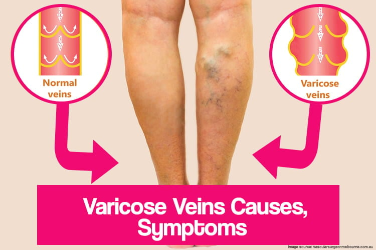 Varicose Veins Causes and Symptoms