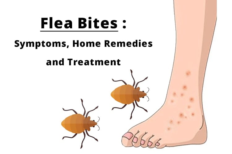 Flea Bites Symptoms and Home remedies