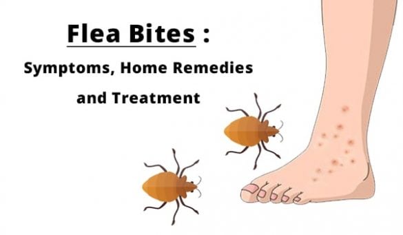 Flea Bites Symptoms and Home remedies