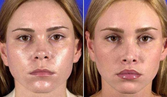 Guide To Revision Rhinoplasty