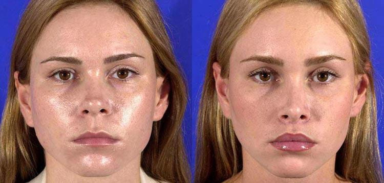 Guide To Revision Rhinoplasty