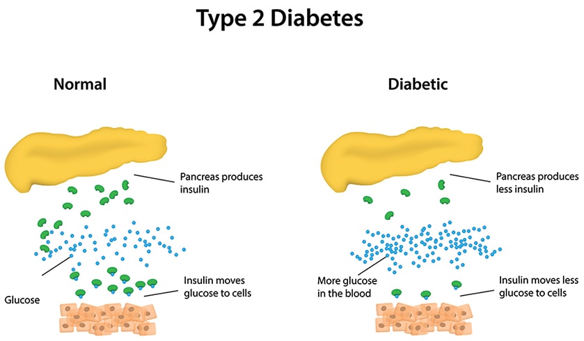 Type-2 Diabetes