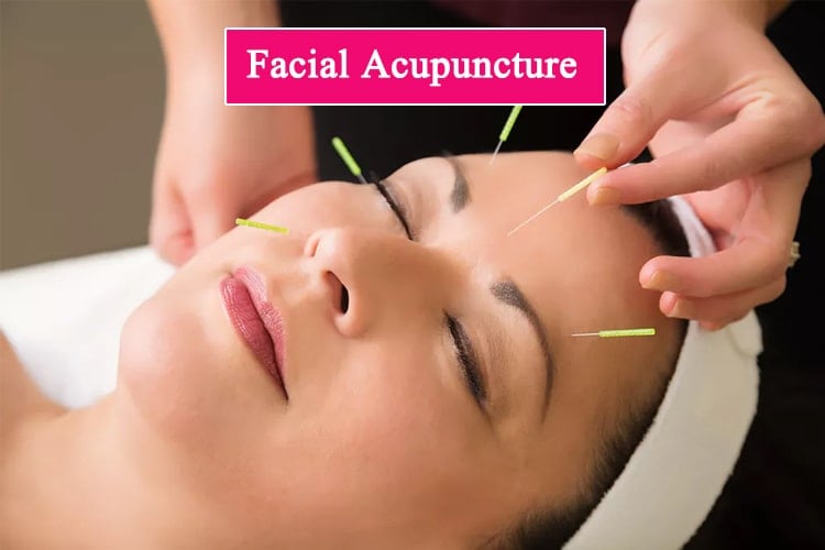 Facial Acupuncture