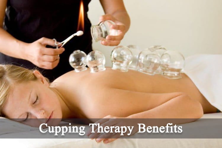 Cupping Therapy