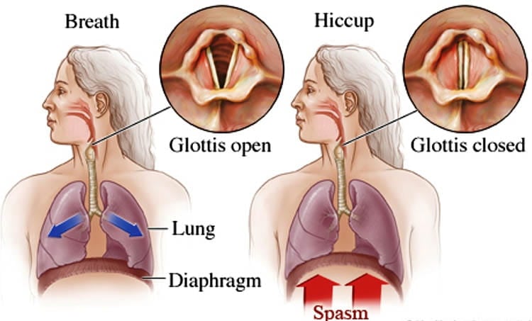 Symptoms Of Hiccups