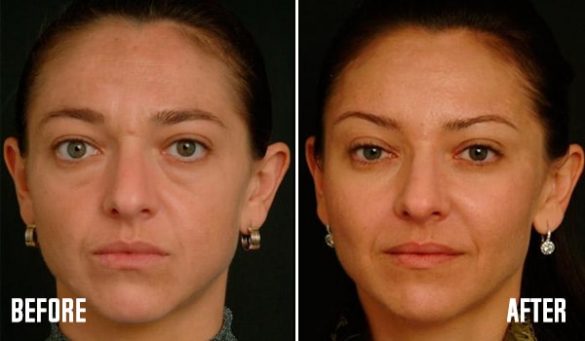 Facial Fat Grafting