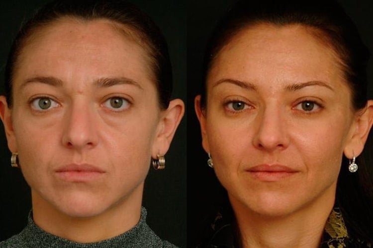 Facial Fat Grafting