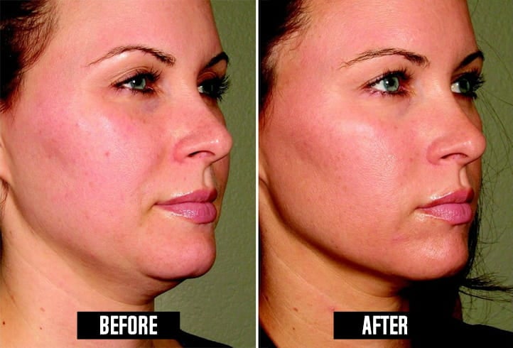 Ultherapy Before And After