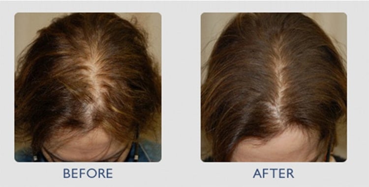 Mesotherapy Before After