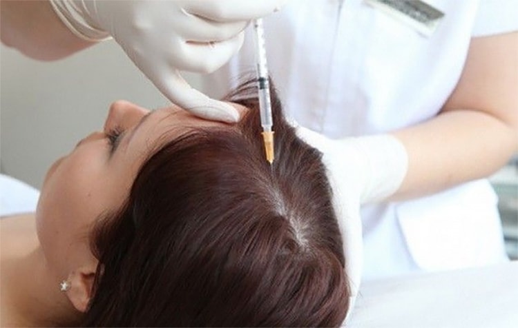 Mesotherapy For Hair Loss