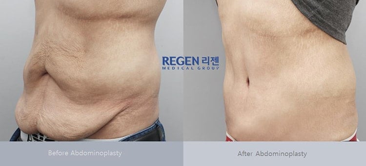 Abdominoplasty Before After