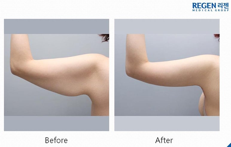 Armplasty Before After