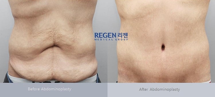 Mini Abdominoplasty