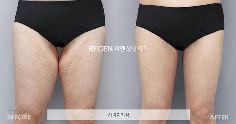 Thighplasty Before After
