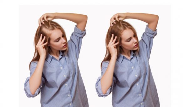 Recovery Tips After Hair Transplant Procedure