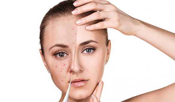 Home Remedies For Cystic Acne