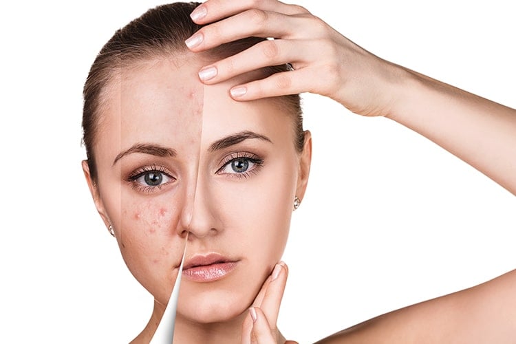 Home Remedies For Cystic Acne