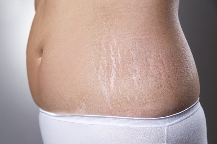 Risk Factors For Stretch Marks