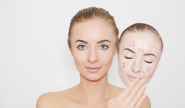 top 10 acne scar removal cream