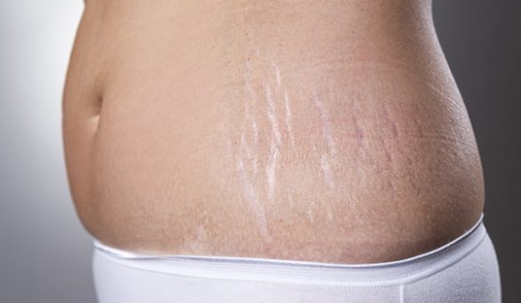 Home Remedies To Reduce Stretch Marks At Home