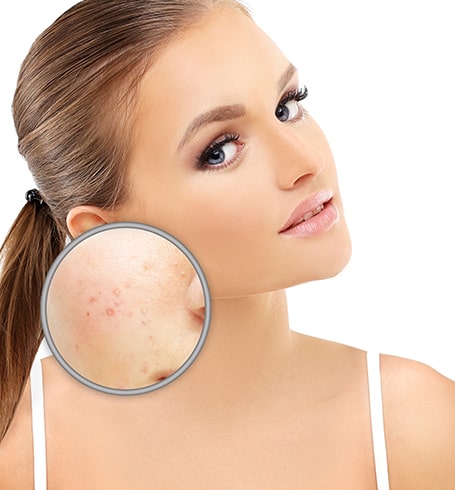 Acne on Skin