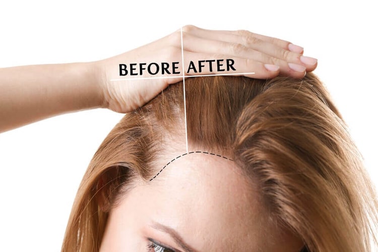 Hair Transplant Before After