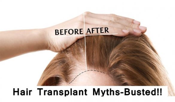 Hair Transplant Myths