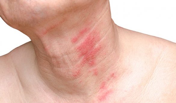 Natural Remedies To Treat Shingles