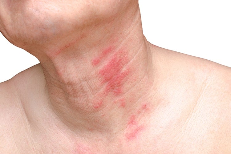 Natural Remedies To Treat Shingles